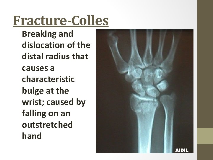 Fracture-Colles Breaking and dislocation of the distal radius that causes a characteristic bulge at