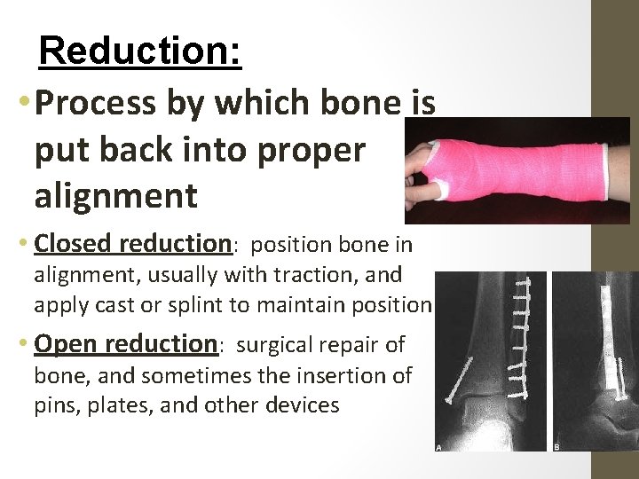 Reduction: • Process by which bone is put back into proper alignment • Closed