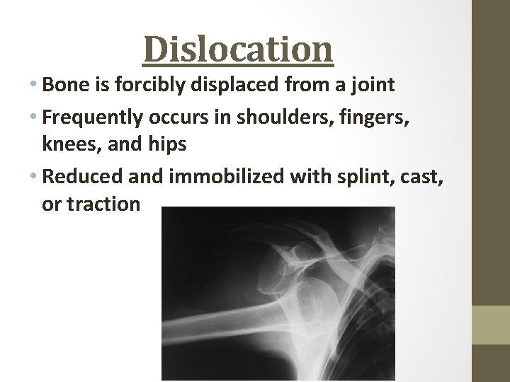  Dislocation • Bone is forcibly displaced from a joint • Frequently occurs in