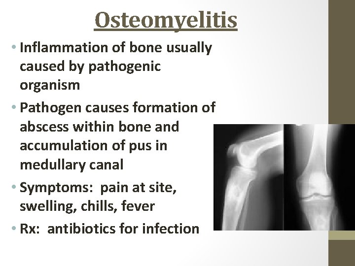 Osteomyelitis • Inflammation of bone usually caused by pathogenic organism • Pathogen causes formation