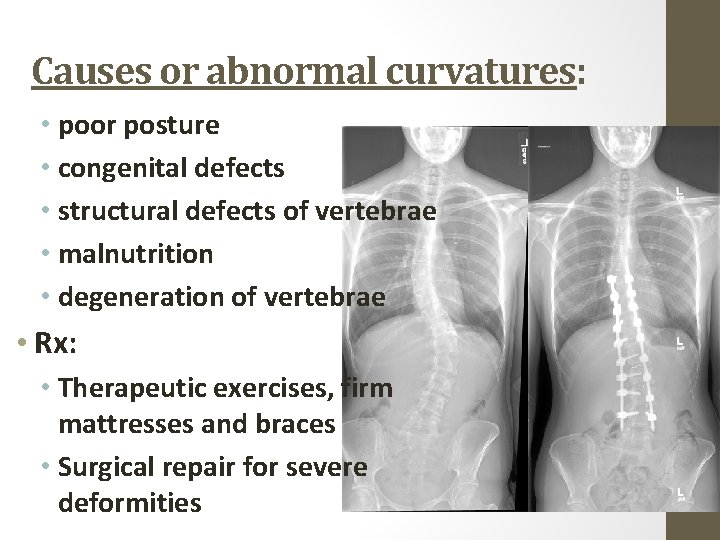 Causes or abnormal curvatures: • poor posture • congenital defects • structural defects of