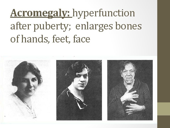 Acromegaly: hyperfunction after puberty; enlarges bones of hands, feet, face 