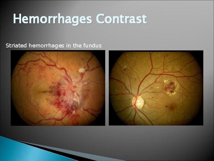 Hemorrhages Contrast Striated hemorrhages in the fundus 