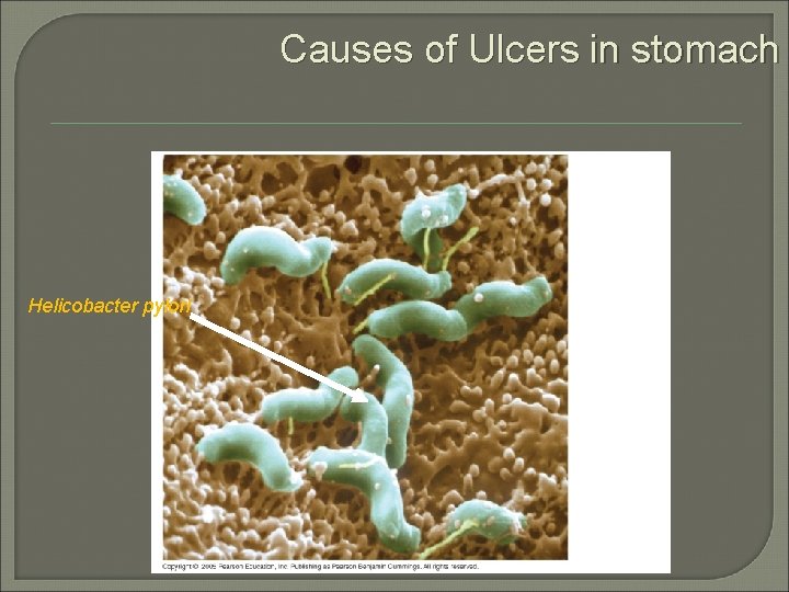 Causes of Ulcers in stomach Helicobacter pylori 