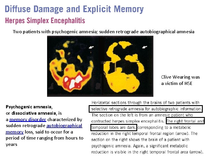 Two patients with psychogenic amnesia; sudden retrograde autobiographical amnesia Clive Wearing was a victim