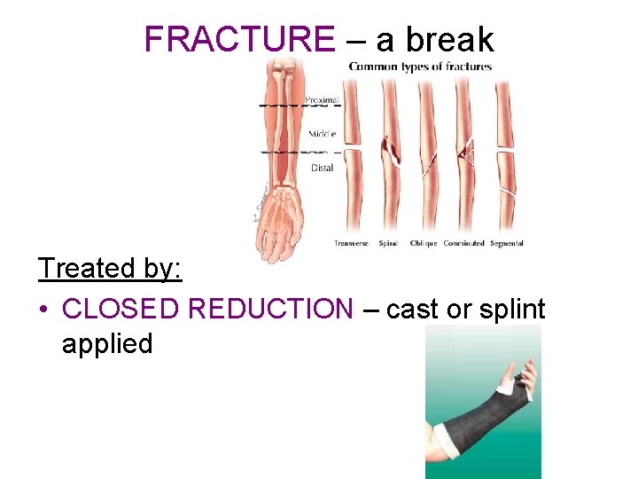 FRACTURE – a break Treated by: • CLOSED REDUCTION – cast or splint applied
