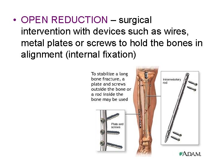  • OPEN REDUCTION – surgical intervention with devices such as wires, metal plates
