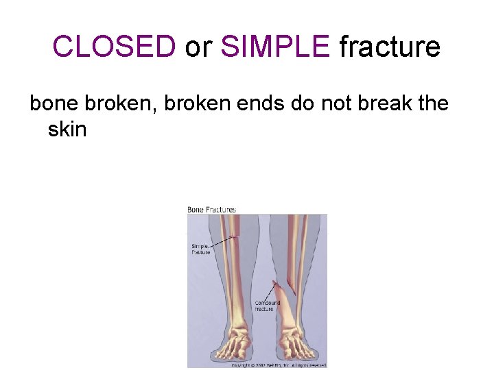 CLOSED or SIMPLE fracture bone broken, broken ends do not break the skin 
