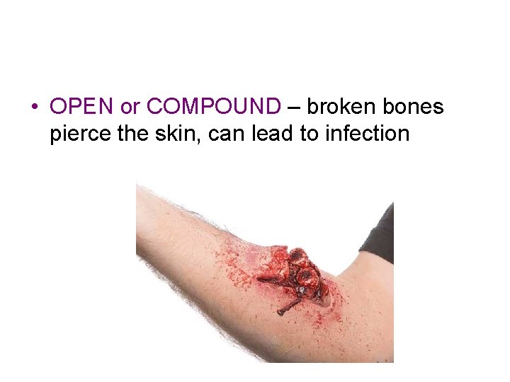 • OPEN or COMPOUND – broken bones pierce the skin, can lead to • OPEN or COMPOUND – broken bones pierce the skin, can lead to