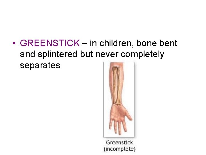  • GREENSTICK – in children, bone bent and splintered but never completely separates