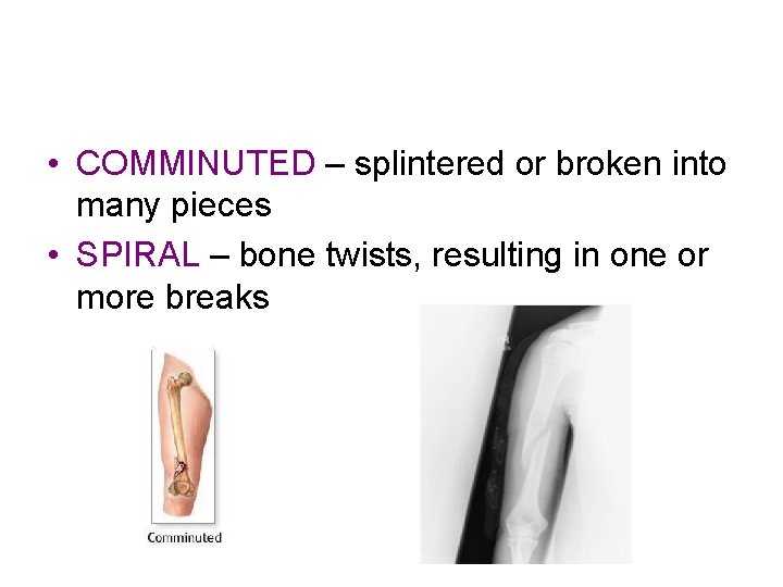  • COMMINUTED – splintered or broken into many pieces • SPIRAL – bone