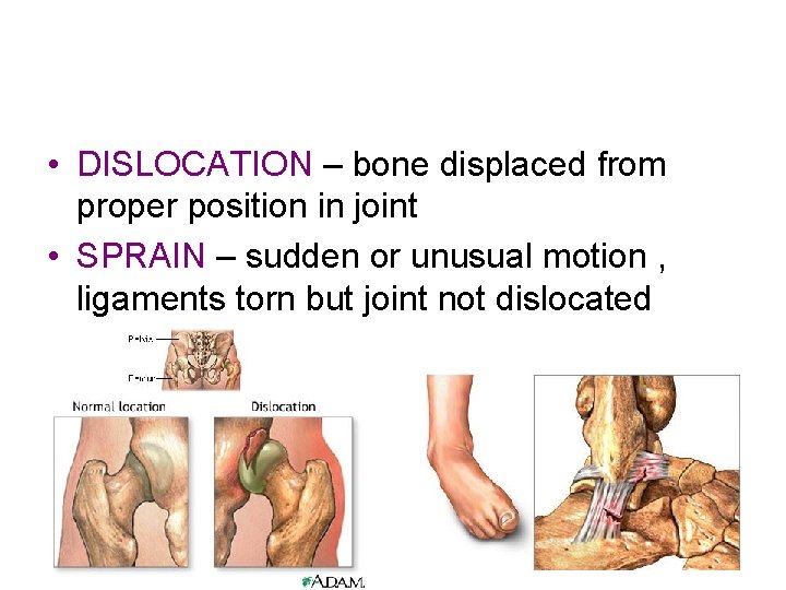  • DISLOCATION – bone displaced from proper position in joint • SPRAIN –