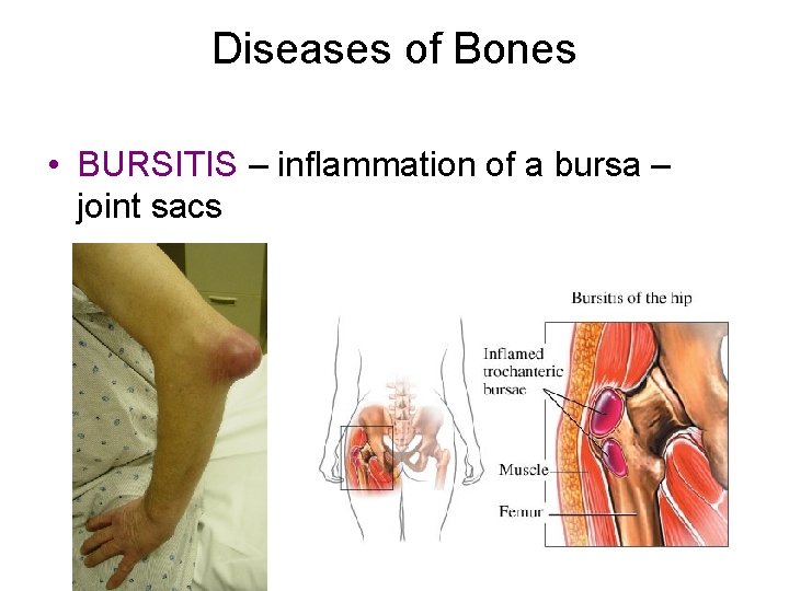 Diseases of Bones • BURSITIS – inflammation of a bursa – joint sacs Diseases of Bones • BURSITIS – inflammation of a bursa – joint sacs