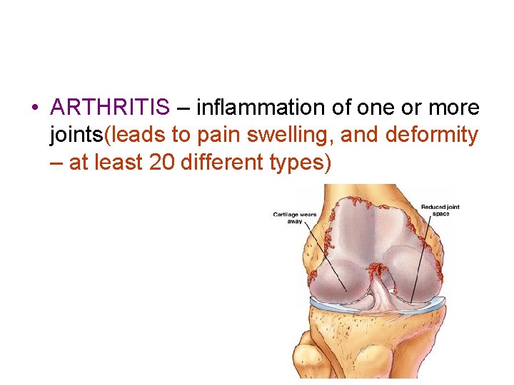 • ARTHRITIS – inflammation of one or more joints(leads to pain swelling, and • ARTHRITIS – inflammation of one or more joints(leads to pain swelling, and