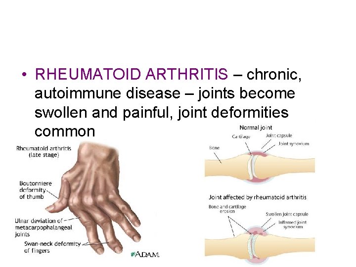  • RHEUMATOID ARTHRITIS – chronic, autoimmune disease – joints become swollen and painful,