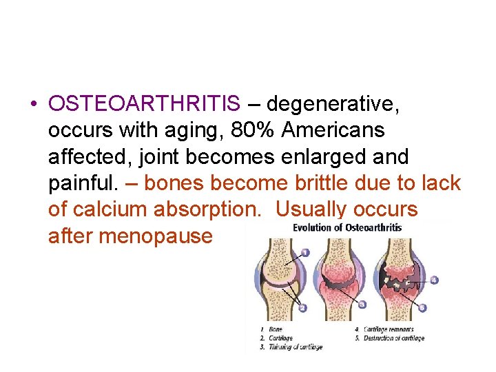 • OSTEOARTHRITIS – degenerative, occurs with aging, 80% Americans affected, joint becomes enlarged • OSTEOARTHRITIS – degenerative, occurs with aging, 80% Americans affected, joint becomes enlarged