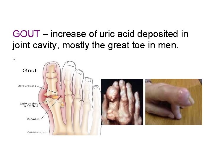 GOUT – increase of uric acid deposited in joint cavity, mostly the great toe