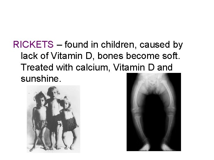 RICKETS – found in children, caused by lack of Vitamin D, bones become soft. RICKETS – found in children, caused by lack of Vitamin D, bones become soft.