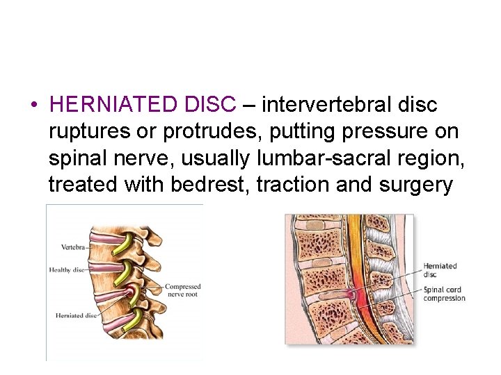  • HERNIATED DISC – intervertebral disc ruptures or protrudes, putting pressure on spinal