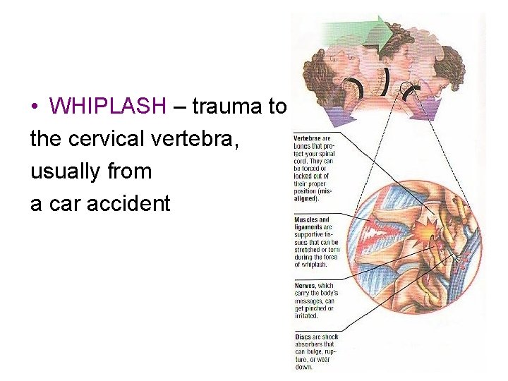  • WHIPLASH – trauma to the cervical vertebra, usually from a car accident