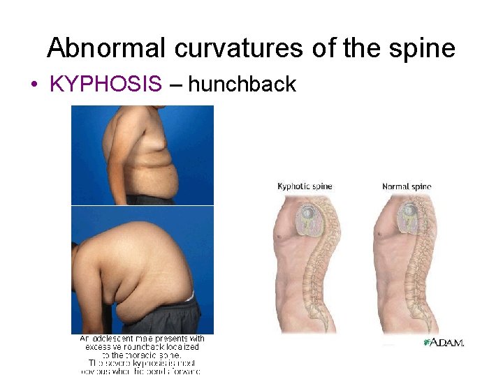 Abnormal curvatures of the spine • KYPHOSIS – hunchback 