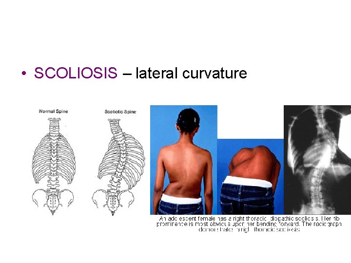  • SCOLIOSIS – lateral curvature 