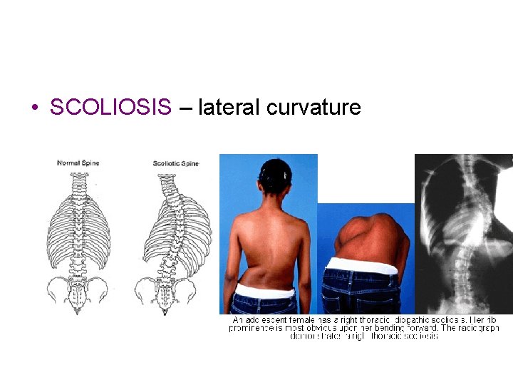 • SCOLIOSIS – lateral curvature • SCOLIOSIS – lateral curvature