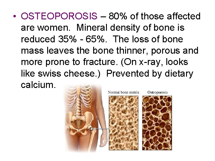  • OSTEOPOROSIS – 80% of those affected are women. Mineral density of bone