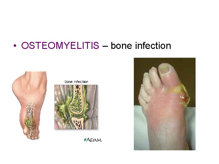 • OSTEOMYELITIS – bone infection • OSTEOMYELITIS – bone infection