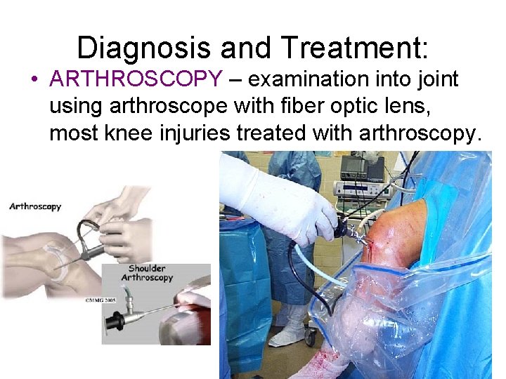 Diagnosis and Treatment: • ARTHROSCOPY – examination into joint using arthroscope with fiber optic