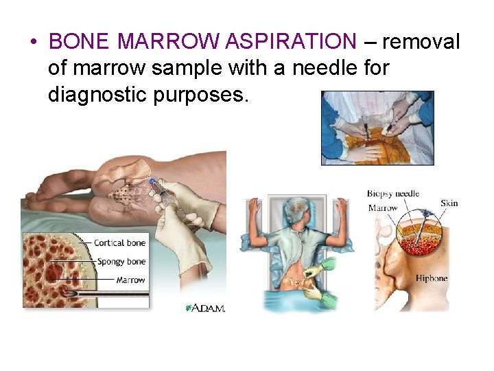  • BONE MARROW ASPIRATION – removal of marrow sample with a needle for