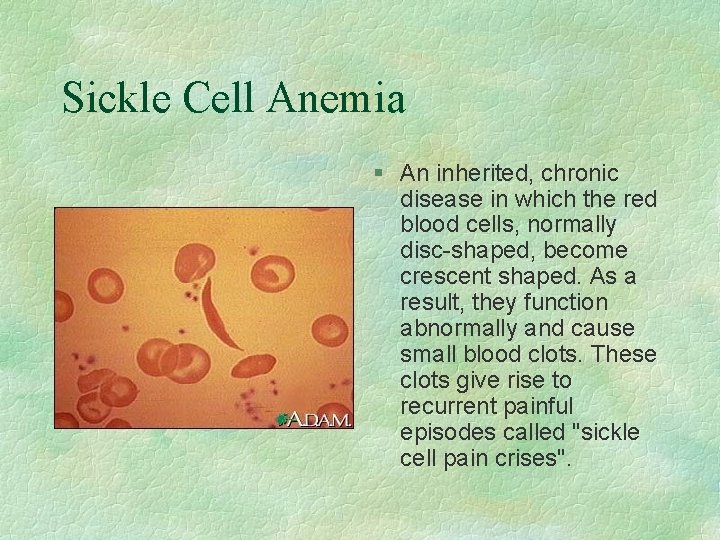 Sickle Cell Anemia § An inherited, chronic disease in which the red blood cells,