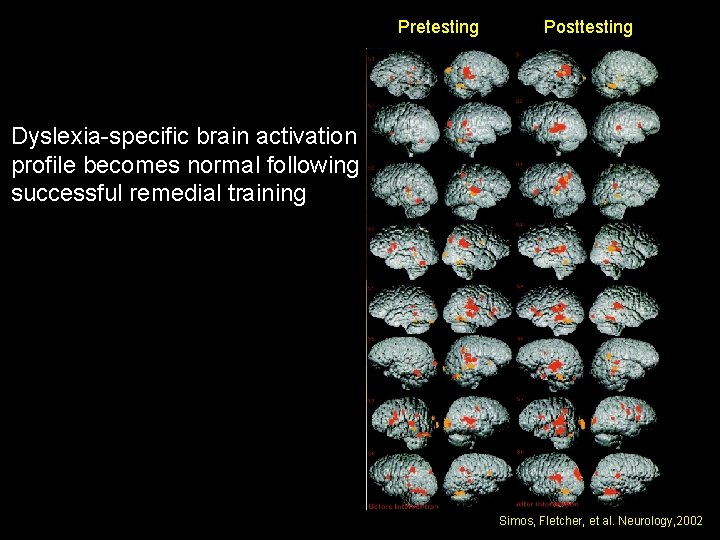  Pretesting Posttesting Dyslexia-specific brain activation profile becomes normal following successful remedial training Simos,