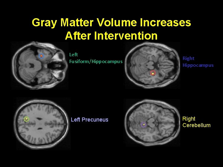 Gray Matter Volume Increases After Intervention Left Fusiform/Hippocampus Left Precuneus Right Hippocampus Right Cerebellum