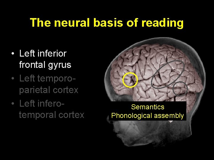 The neural basis of reading • Left inferior frontal gyrus • Left temporoparietal cortex