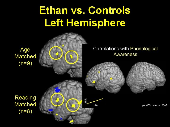 Ethan vs. Controls Left Hemisphere Age Matched (n=9) Reading Matched (n=8) 