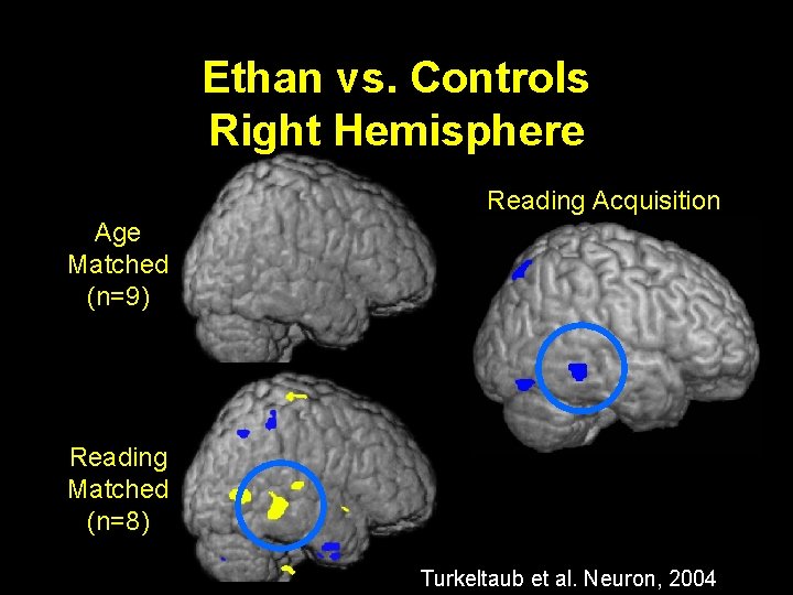 Ethan vs. Controls Right Hemisphere Reading Acquisition Age Matched (n=9) Reading Matched (n=8) Turkeltaub