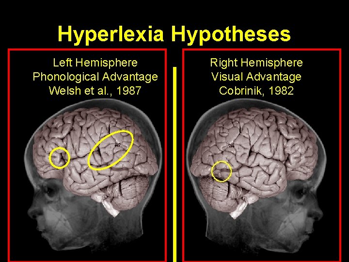 Hyperlexia Hypotheses Left Hemisphere Phonological Advantage Welsh et al. , 1987 Right Hemisphere Visual