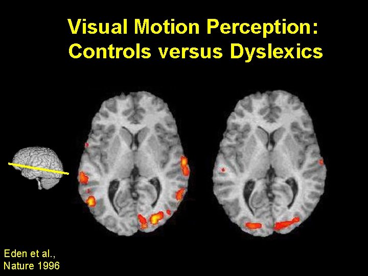 Visual Motion Perception: Controls versus Dyslexics Eden et al. , Nature 1996 