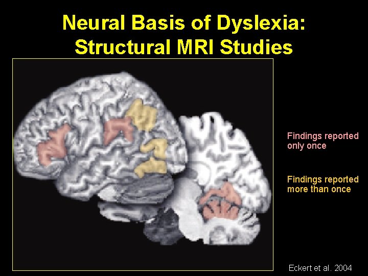 Neural Basis of Dyslexia: Structural MRI Studies Findings reported only once Findings reported more