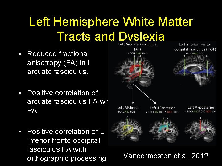 Left Hemisphere White Matter Tracts and Dyslexia • Reduced fractional anisotropy (FA) in L