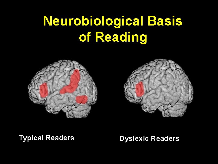Neurobiological Basis of Reading Typical Readers Dyslexic Readers 