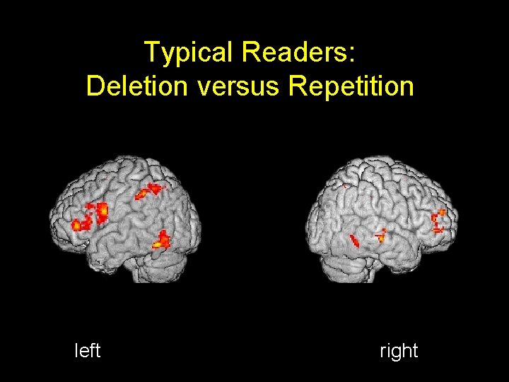 Typical Readers: Deletion versus Repetition left right 