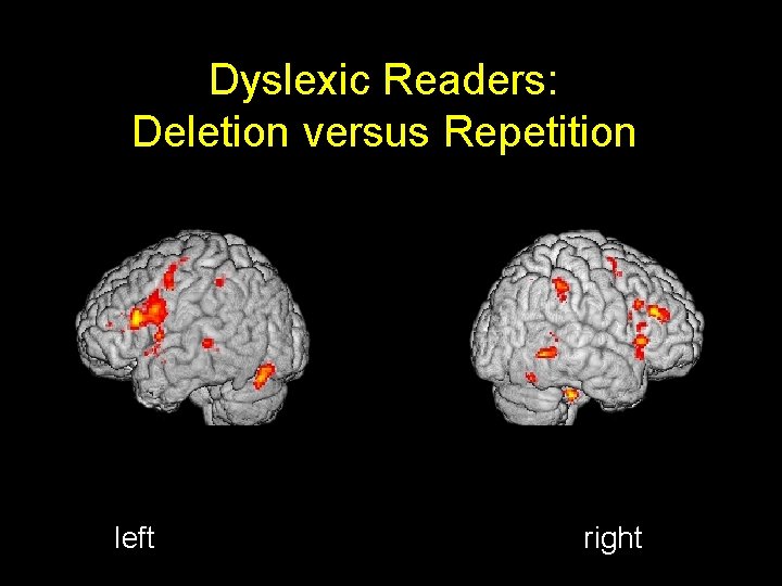 Dyslexic Readers: Deletion versus Repetition left right 