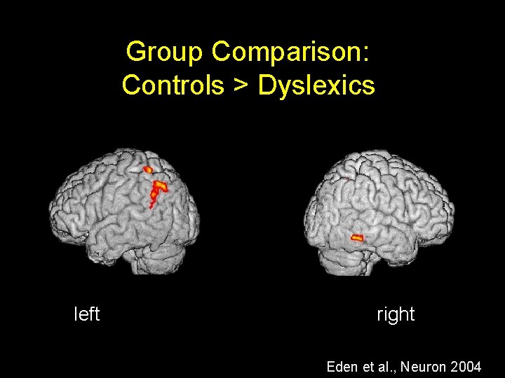 Group Comparison: Controls > Dyslexics left right Eden et al. , Neuron 2004 
