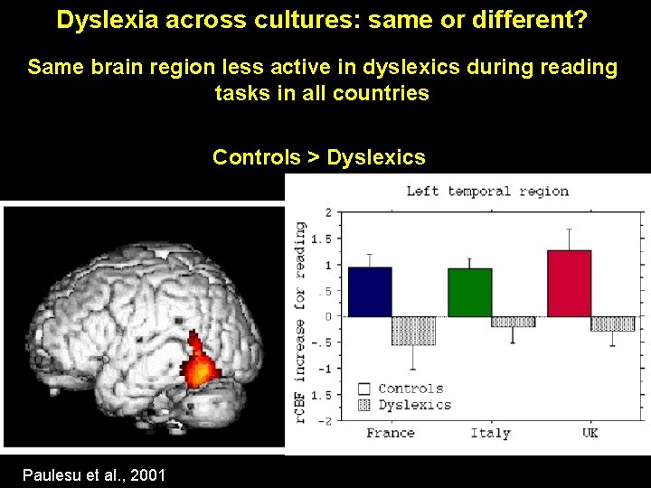 Dyslexia across cultures: same or different? Same brain region less active in dyslexics during