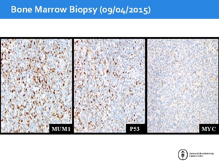 Bone Marrow Biopsy (09/04/2015) MUM 1 P 53 MYC 