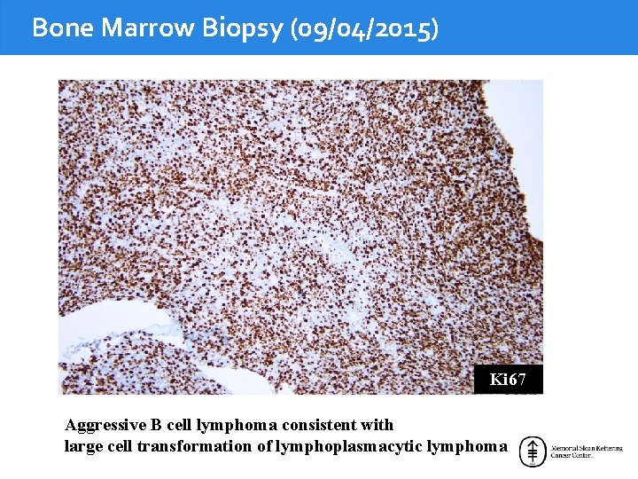 Bone Marrow Biopsy (09/04/2015) Ki 67 Aggressive B cell lymphoma consistent with large cell