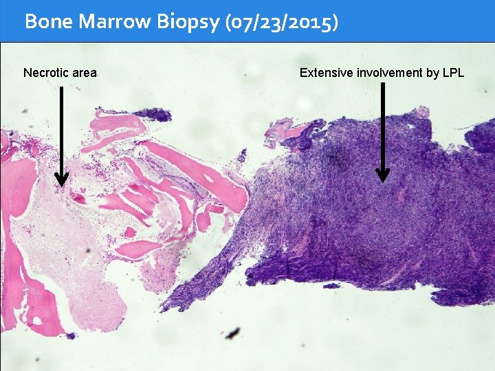 Bone Marrow Biopsy (07/23/2015) Necrotic area Extensive involvement by LPL 