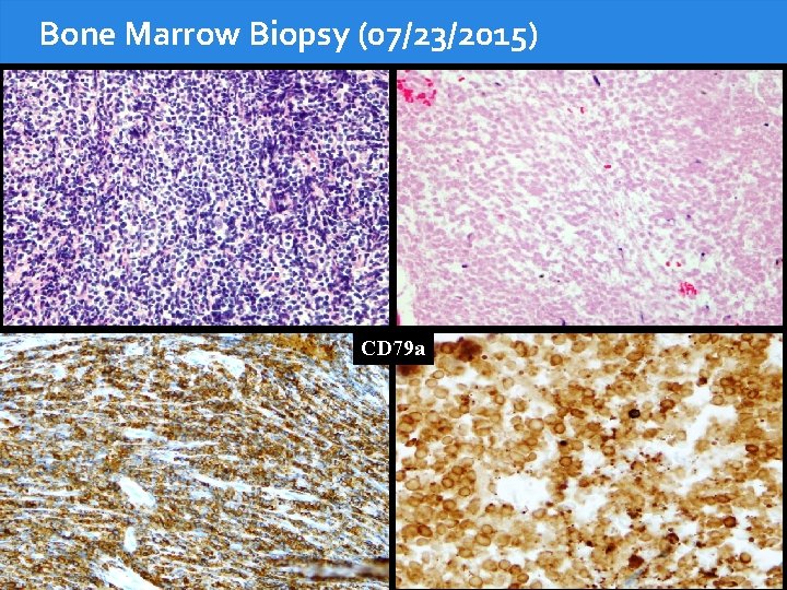 Bone Marrow Biopsy (07/23/2015) CD 79 a 